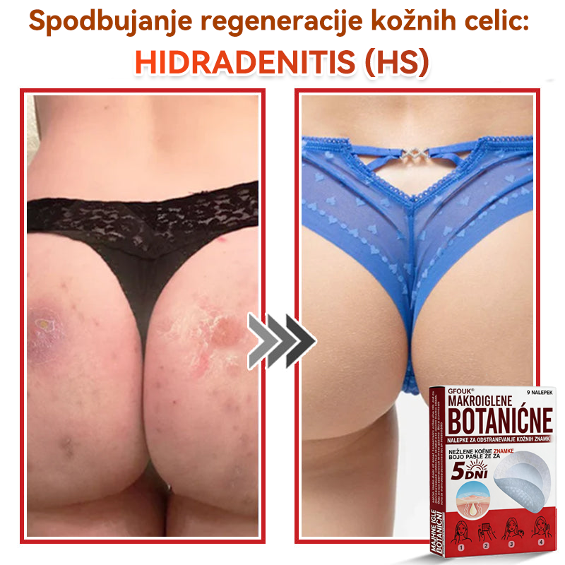 🗽✅GFOUK®Botanični obliž z mikroiglami za odstranjevanje kožnih izrastkov