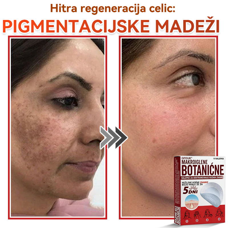 🗽✅GFOUK®Botanični obliž z mikroiglami za odstranjevanje kožnih izrastkov