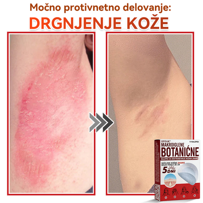 🗽✅GFOUK®Botanični obliž z mikroiglami za odstranjevanje kožnih izrastkov